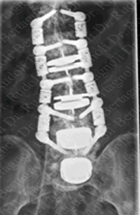 degenerative scoliosis