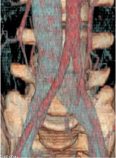 CT Angiogram