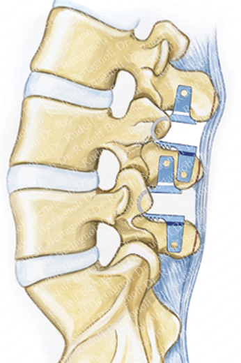 Coflex two levels