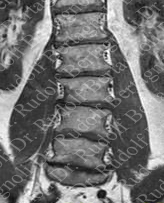 degnerative scoliosis