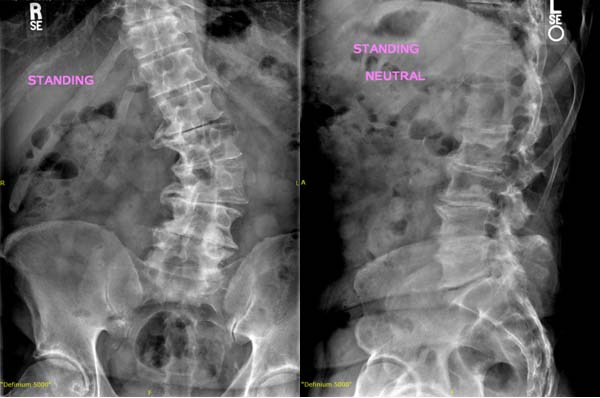 Degenerative Scoliosis