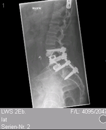 Fusion Revision Post-op