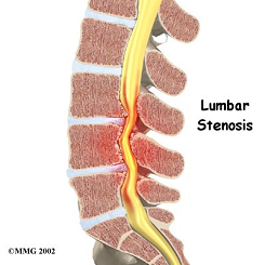 spinal-stenosis